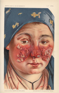 Lupus vulgaris